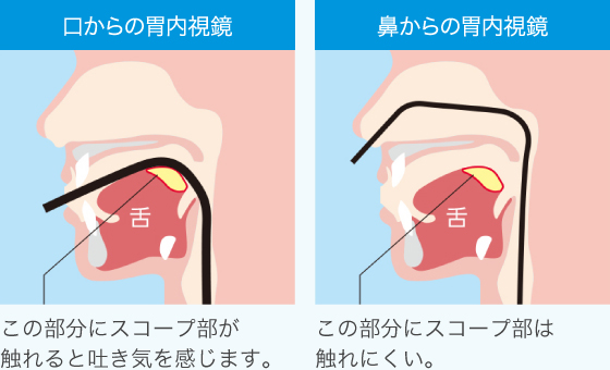 経鼻内視鏡は嘔吐反射の苦痛を軽減